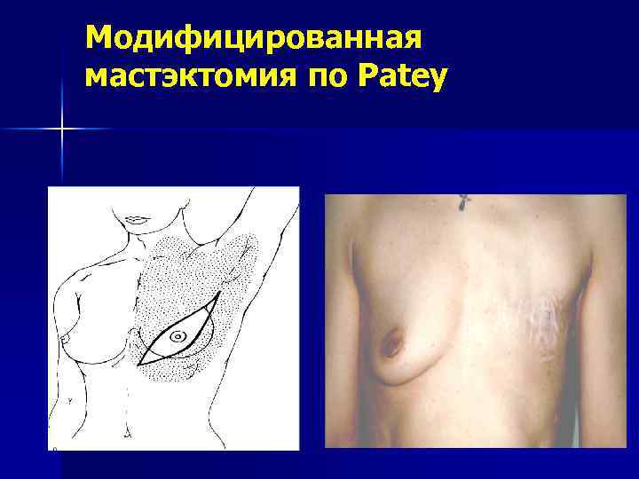 Модифицированная мастэктомия по Patey 