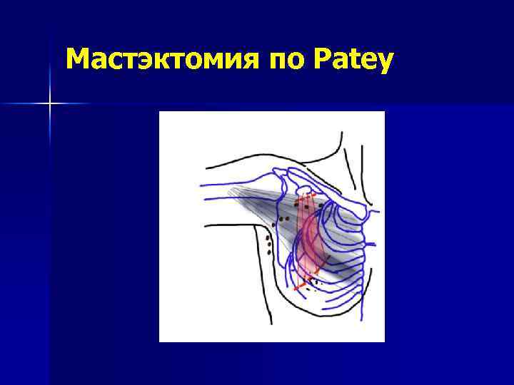 Мастэктомия по Patey 