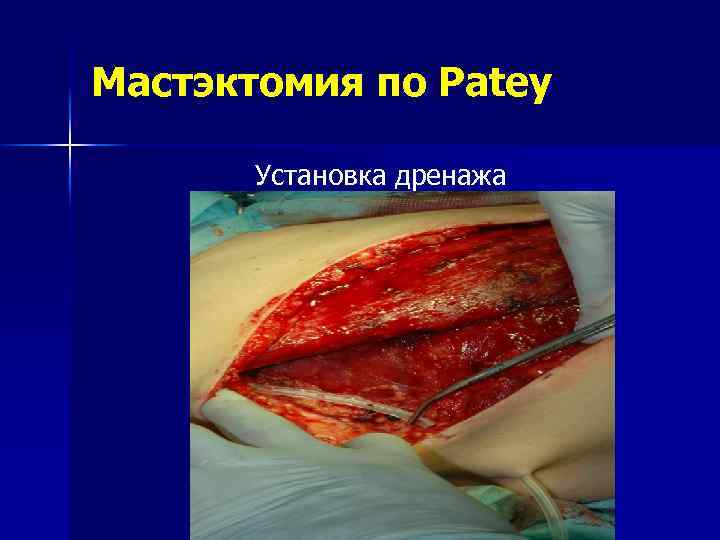 Мастэктомия по Patey Установка дренажа 