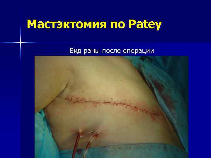 Мастэктомия по Patey Вид раны после операции 