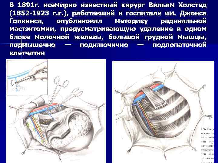 В 1891 г. всемирно известный хирург Вильям Холстед (1852 -1923 г. г. ), работавший