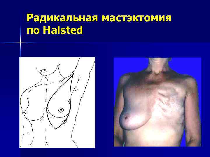 Радикальная мастэктомия по Halsted 