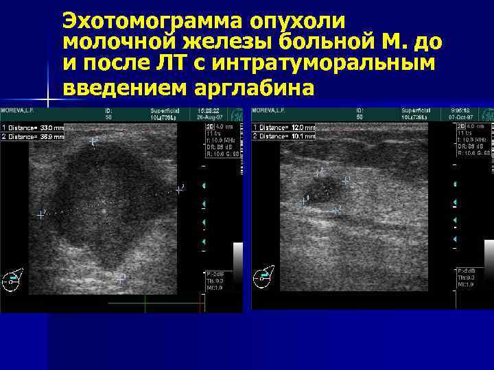 Эхотомограмма опухоли молочной железы больной М. до и после ЛТ с интратуморальным введением арглабина