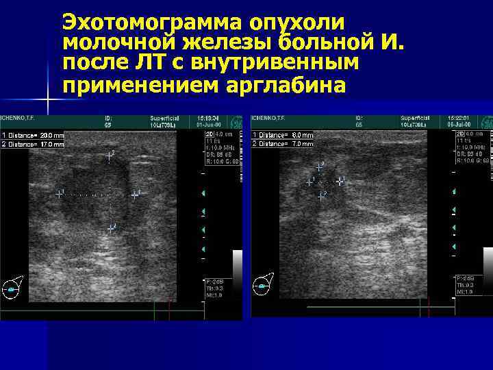 Эхотомограмма опухоли молочной железы больной И. после ЛТ с внутривенным применением арглабина 