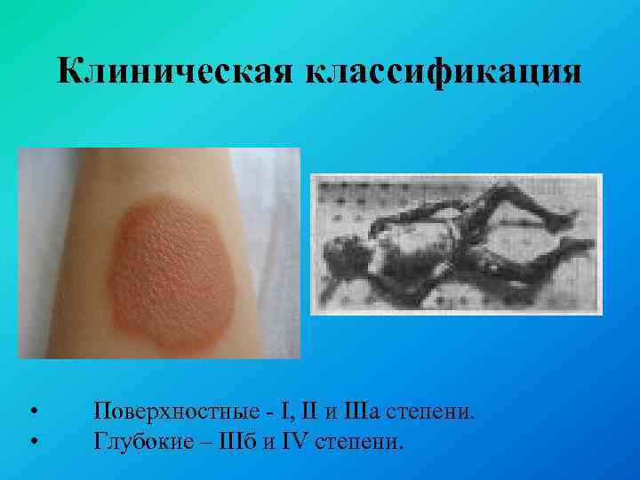 Клиническая классификация • • Поверхностные - I, II и IIIa степени. Глубокие – IIIб
