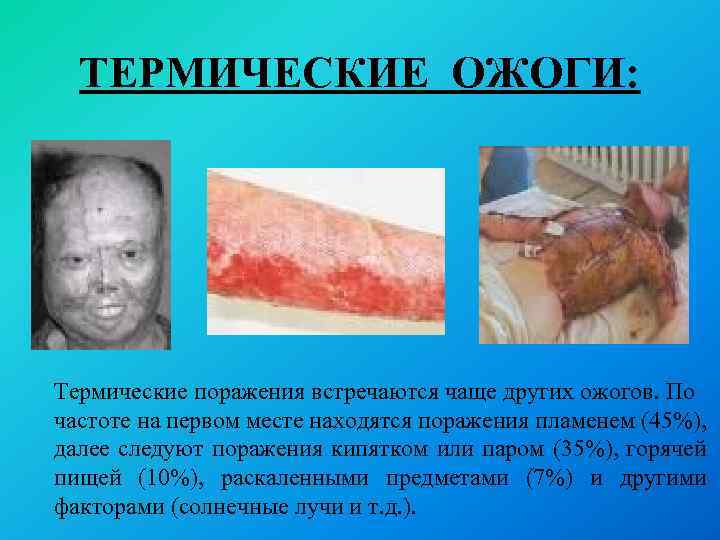 ТЕРМИЧЕСКИЕ ОЖОГИ: Термические поражения встречаются чаще других ожогов. По частоте на первом месте находятся