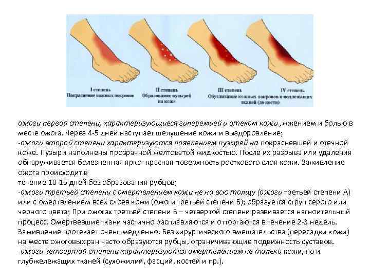 ожоги первой степени, характеризующиеся гиперемией и отеком кожи , жжением и болью в месте