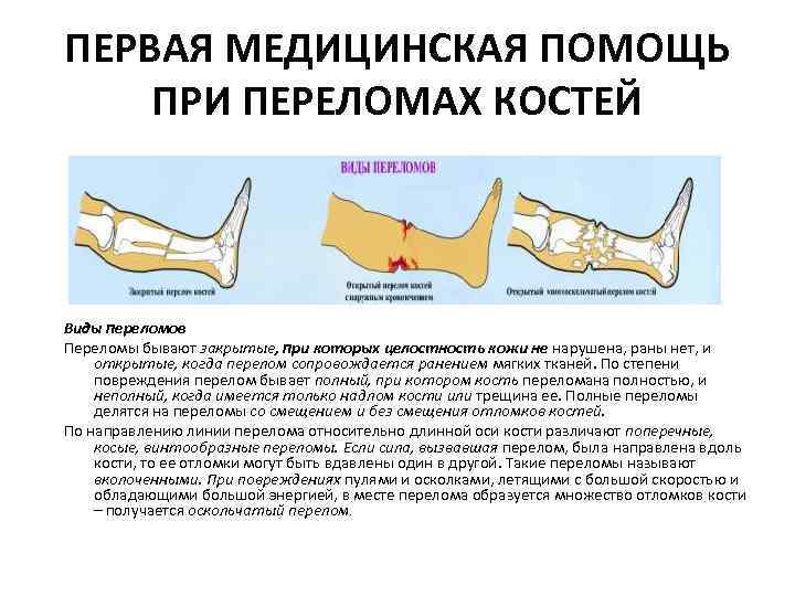 ПЕРВАЯ МЕДИЦИНСКАЯ ПОМОЩЬ ПРИ ПЕРЕЛОМАХ КОСТЕЙ Виды переломов Переломы бывают закрытые, при которых целостность