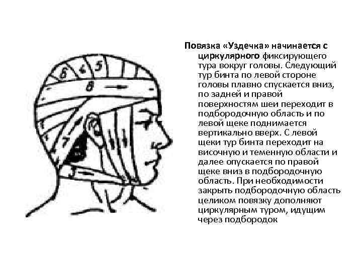 Повязка «Уздечка» начинается с циркулярного фиксирующего тура вокруг головы. Следующий тур бинта по левой