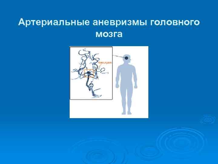 Артериальные аневризмы головного мозга 