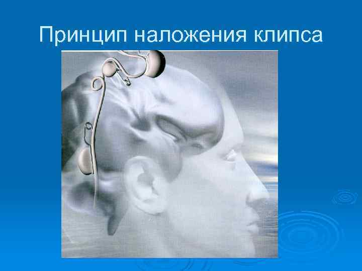 Принцип наложения клипса 