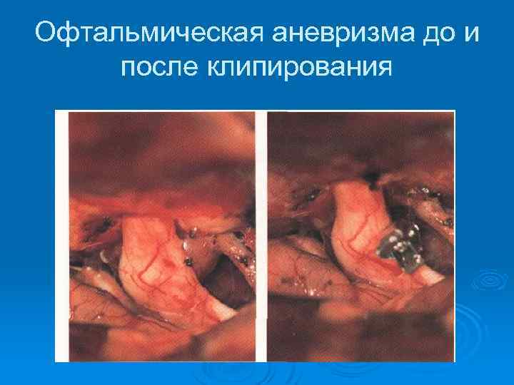 Офтальмическая аневризма до и после клипирования 