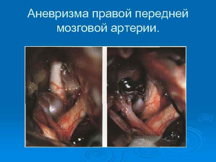 Аневризма правой передней мозговой артерии. 
