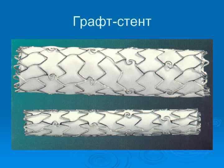 Графт-стент 