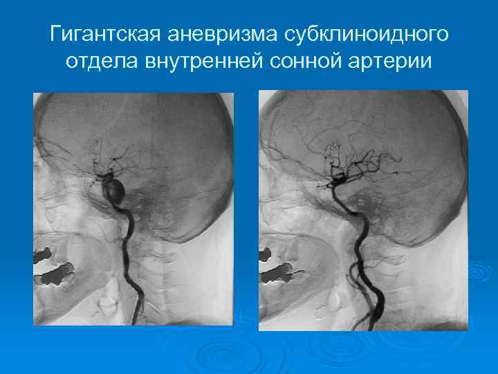 Гигантская аневризма субклиноидного отдела внутренней сонной артерии 