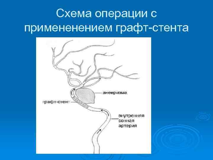 Схема операции с примененением графт-стента 