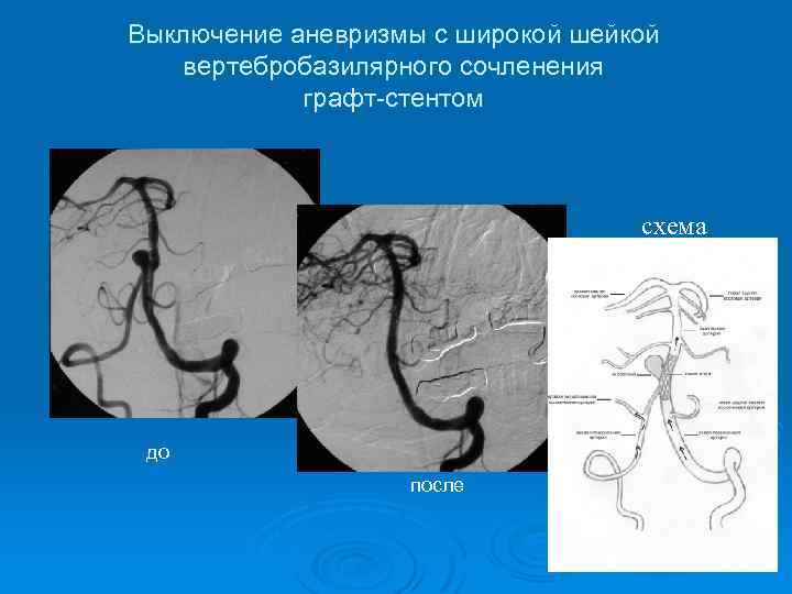 Выключение аневризмы с широкой шейкой вертебробазилярного сочленения графт-стентом схема до после 