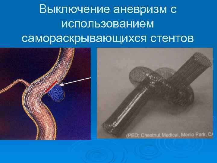 Выключение аневризм с использованием самораскрывающихся стентов 