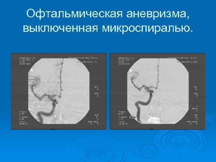 Офтальмическая аневризма, выключенная микроспиралью. 