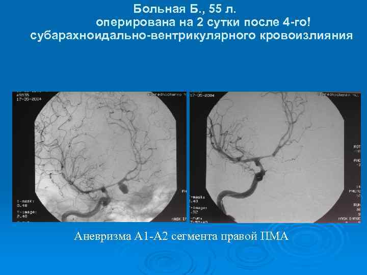 Больная Б. , 55 л. оперирована на 2 сутки после 4 -го! субарахноидально-вентрикулярного кровоизлияния