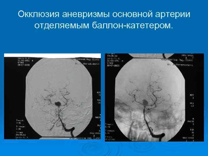 Окклюзия аневризмы основной артерии отделяемым баллон-катетером. 