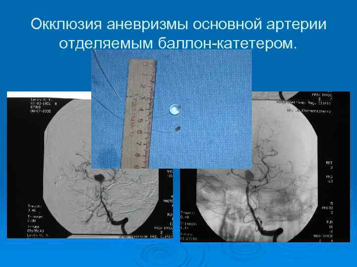 Окклюзия аневризмы основной артерии отделяемым баллон-катетером. 