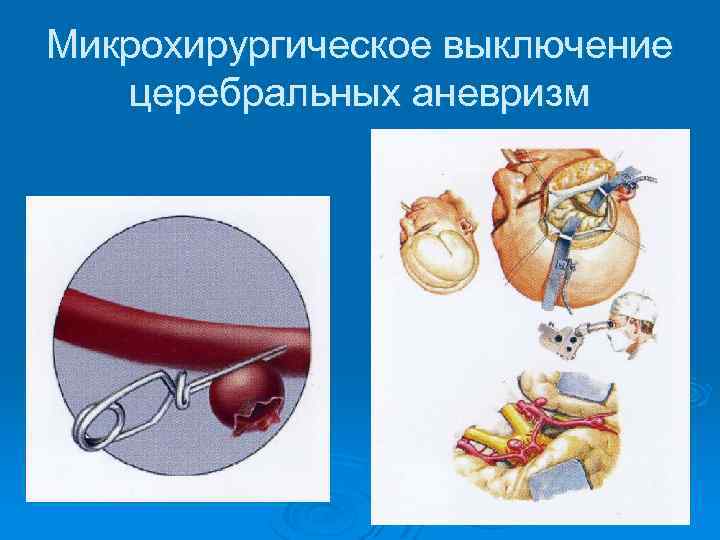 Микрохирургическое выключение церебральных аневризм 