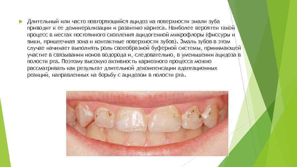  Длительный или часто повторяющийся ацидоз на поверхности эмали зуба приводит к ее деминерализации