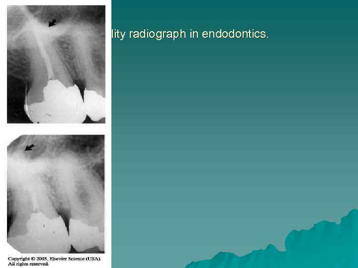 Quality radiograph in endodontics. 
