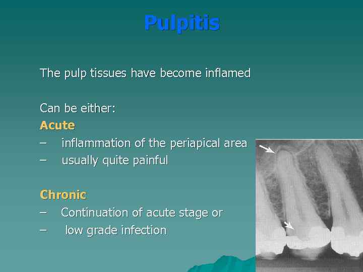 Pulpitis The pulp tissues have become inflamed Can be either: Acute – inflammation of