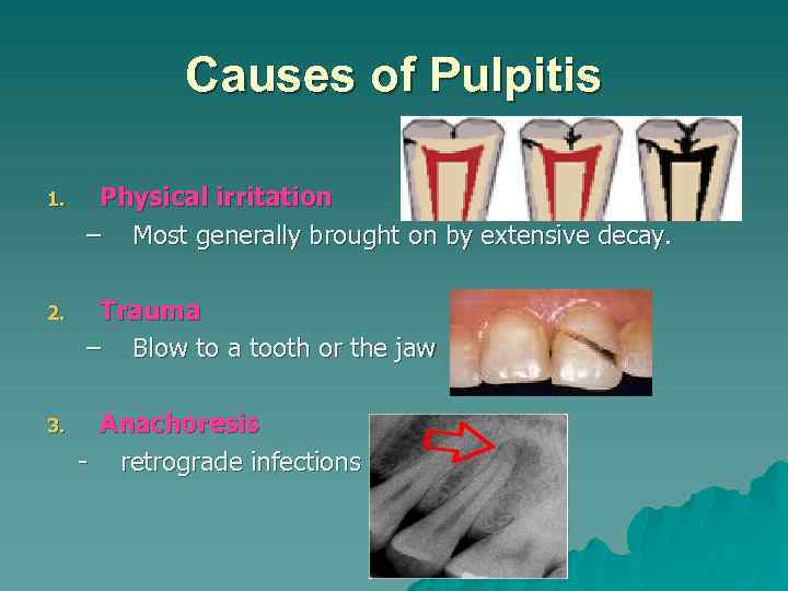Causes of Pulpitis 1. Physical irritation – Most generally brought on by extensive decay.