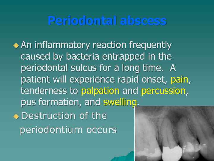 Periodontal abscess u An inflammatory reaction frequently caused by bacteria entrapped in the periodontal