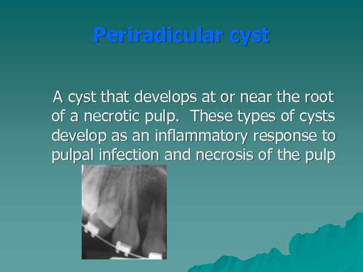 Periradicular cyst A cyst that develops at or near the root of a necrotic