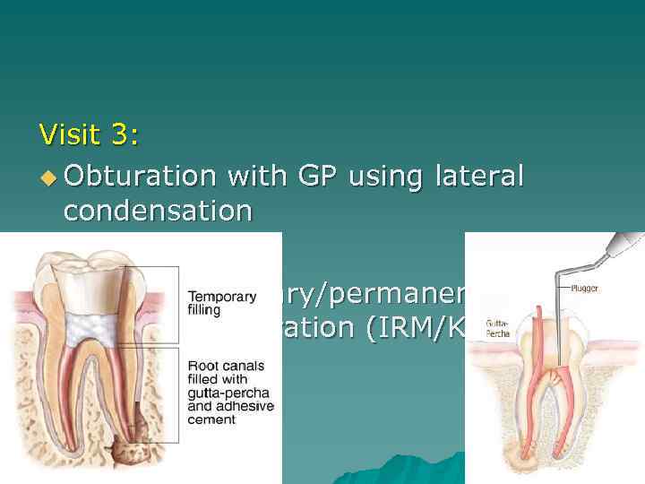 Visit 3: u Obturation with GP using lateral condensation u Placed temporary/permanent restoration (IRM/Kalzinol)