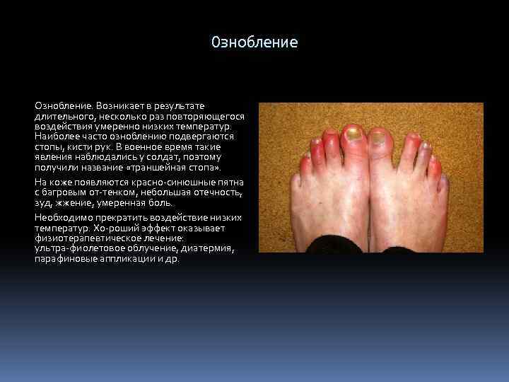 Ознобление. Возникает в результате длительного, несколько раз повторяющегося воздействия умеренно низких температур. Наиболее часто