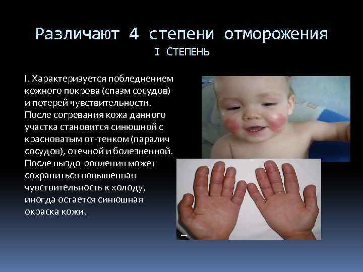 Различают 4 степени отморожения I СТЕПЕНЬ I. Характеризуется побледнением кожного покрова (спазм сосудов) и