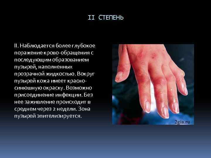 II СТЕПЕНЬ II. Наблюдается более глубокое поражение крово обращения с последующим образованием пузырей, наполненных