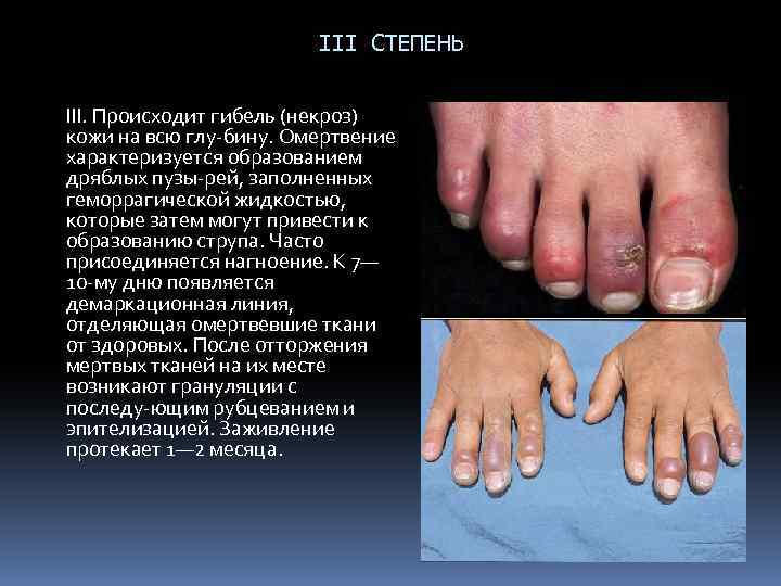 III СТЕПЕНЬ III. Происходит гибель (некроз) кожи на всю глу бину. Омертвение характеризуется образованием