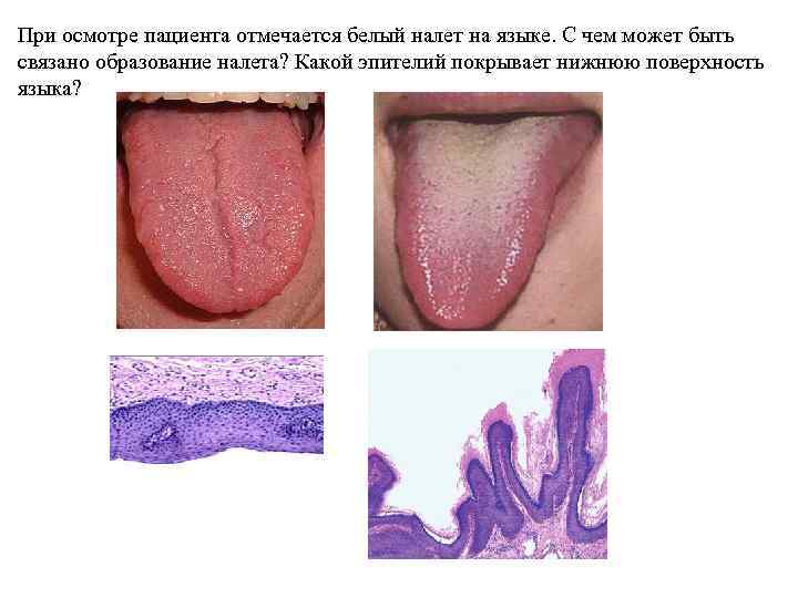 При осмотре пациента отмечается белый налет на языке. С чем может быть связано образование