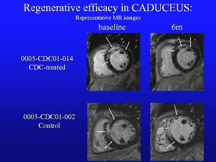 Regenerative efficacy in CADUCEUS: Representative MR images baseline 0005 -CDC 01 -014 CDC-treated 0005