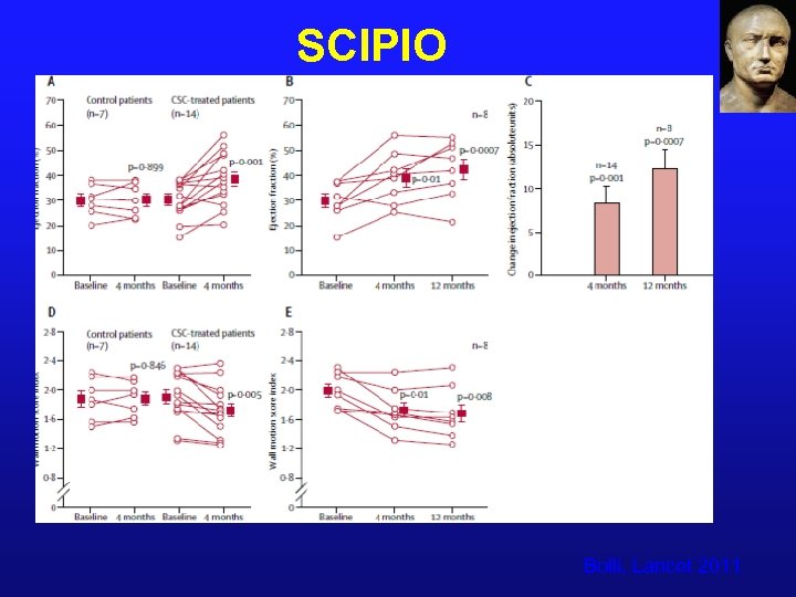 SCIPIO Bolli, Lancet 2011 