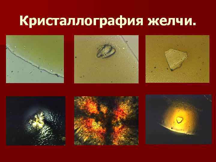 Кристаллография желчи. 