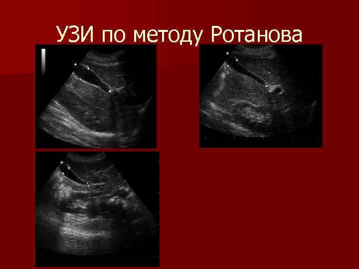 УЗИ по методу Ротанова 