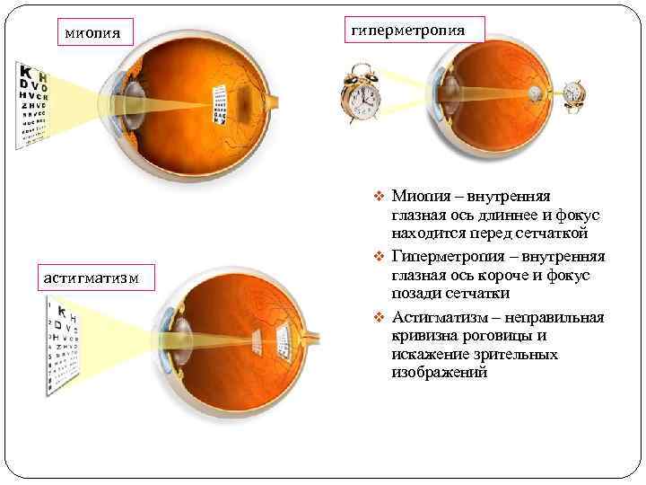 миопия гиперметропия v Миопия – внутренняя астигматизм глазная ось длиннее и фокус находится перед