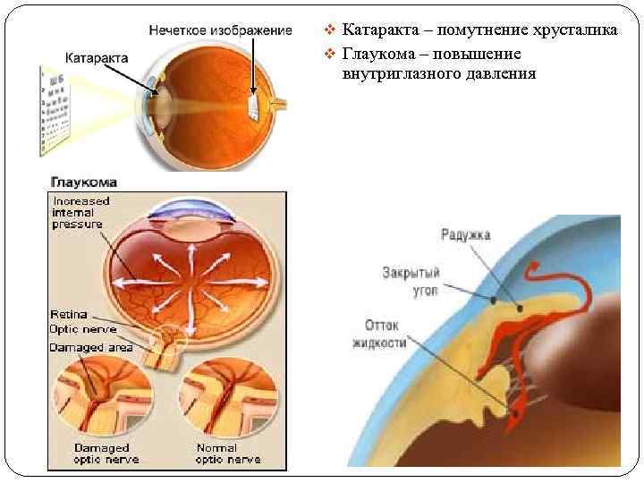 v Катаракта – помутнение хрусталика v Глаукома – повышение внутриглазного давления 