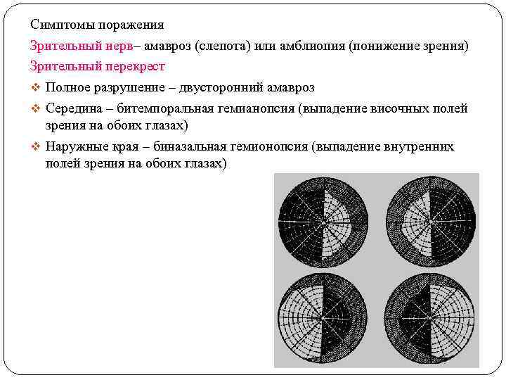 Симптомы поражения Зрительный нерв– амавроз (слепота) или амблиопия (понижение зрения) Зрительный перекрест v Полное