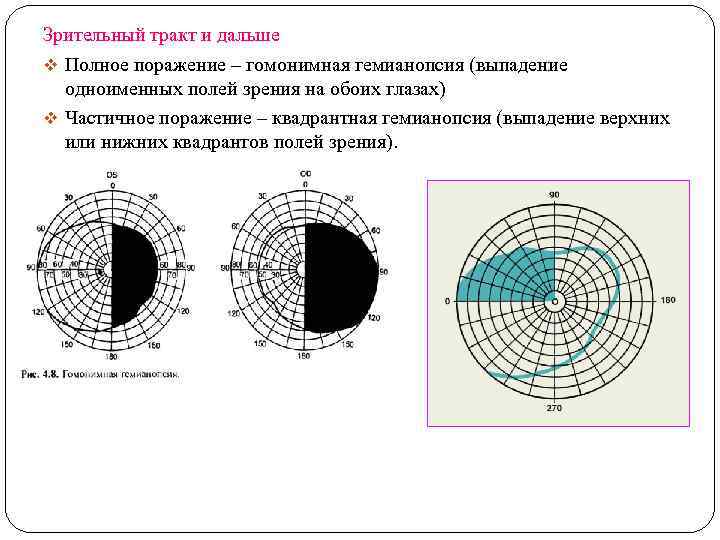 Зрительный тракт и дальше v Полное поражение – гомонимная гемианопсия (выпадение одноименных полей зрения