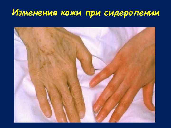 Изменения кожи при сидеропении 