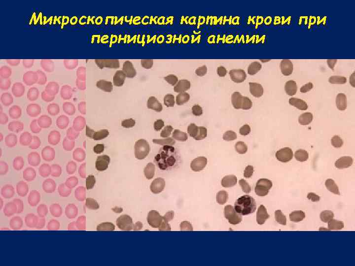 Микроскопическая картина крови при пернициозной анемии 