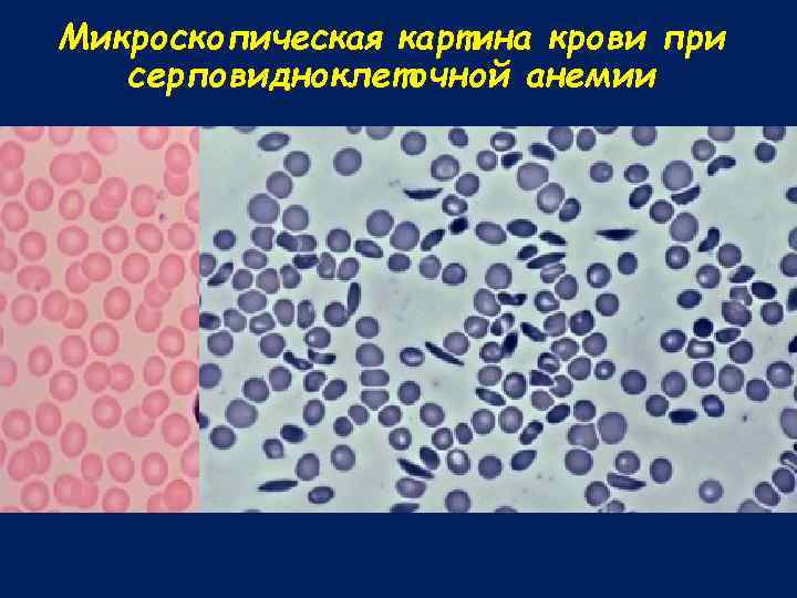 Микроскопическая картина крови при серповидноклеточной анемии 